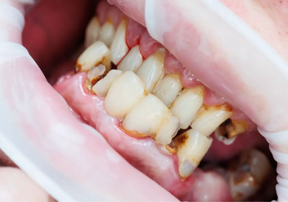 Frequently Asked Questions about Front Teeth Cavities