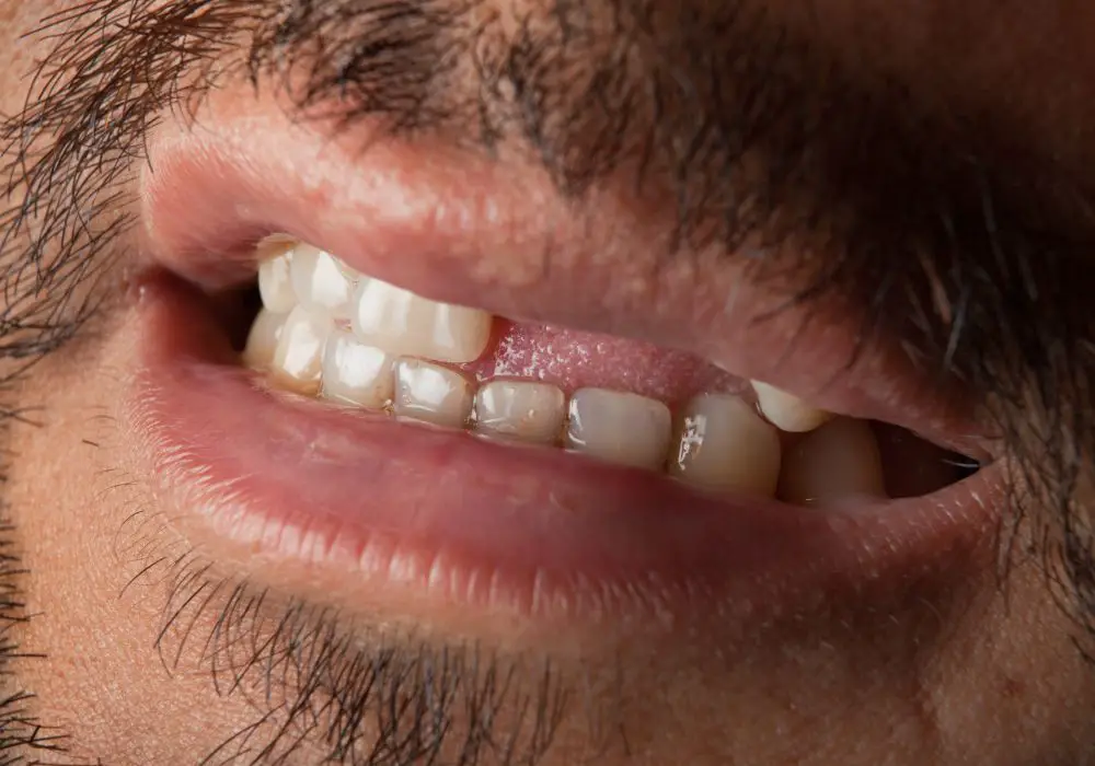 Front tooth implant timeline