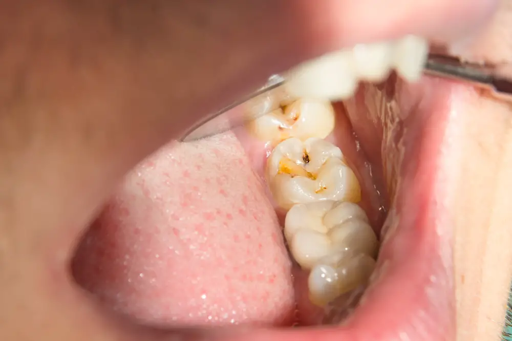 How can I temporarily fill a hole in my tooth? - Find A Dentist, DentalVibe