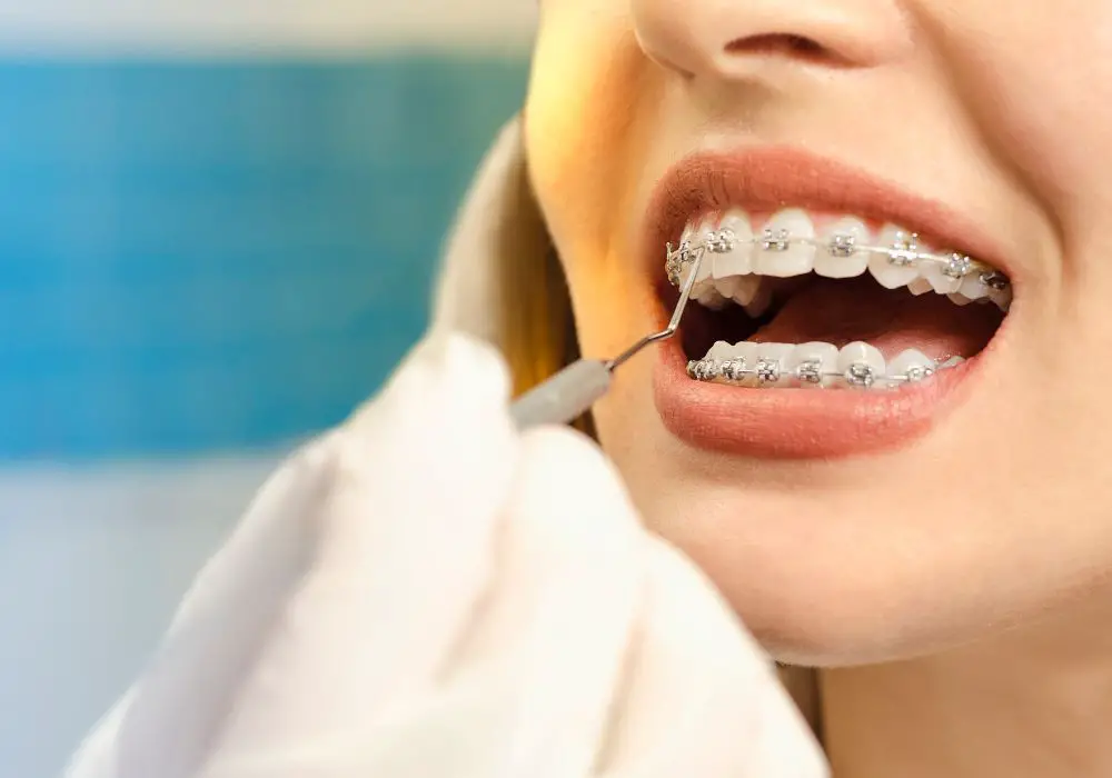 How Do Braces Move Teeth Over Time?