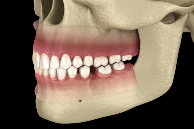 How Fast Can a Tooth Shift? A Quick Guide to Tooth Movement