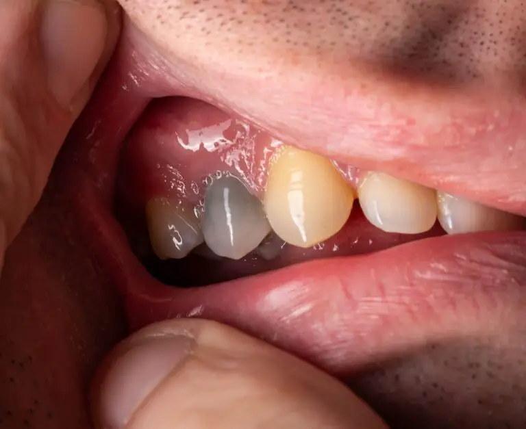 How Long Can A Tooth Be Dead For? (Affecting Factors & Treatments)