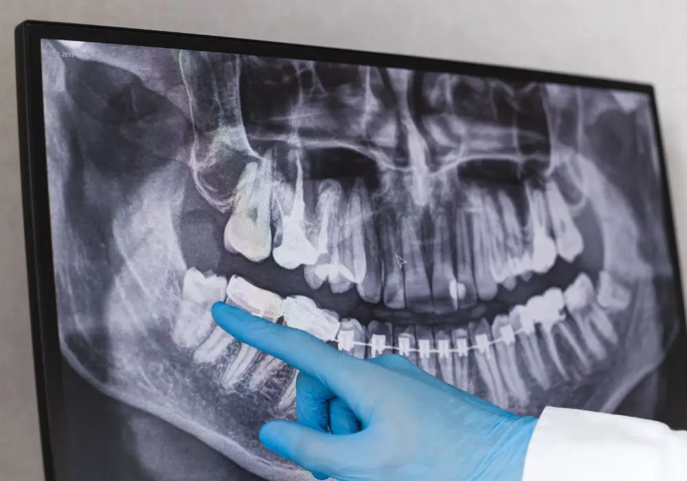 How Long Can You Leave Wisdom Tooth Pain Untreated?