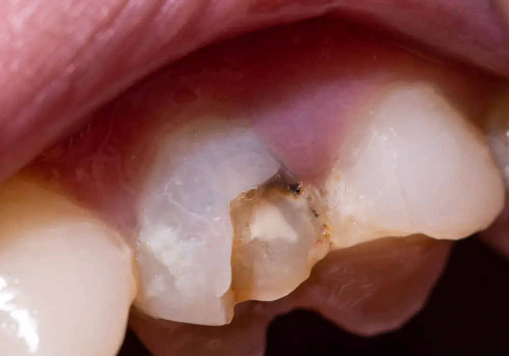 How Long Can a Dead Tooth Stay in the Mouth?