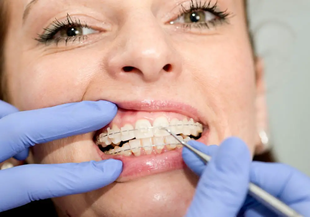 How Orthodontists Determine Which Teeth to Extract