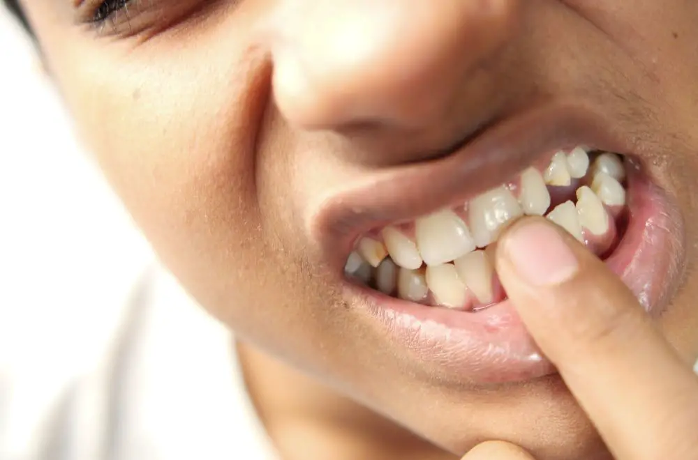How Tooth Decay Contributes to Sting