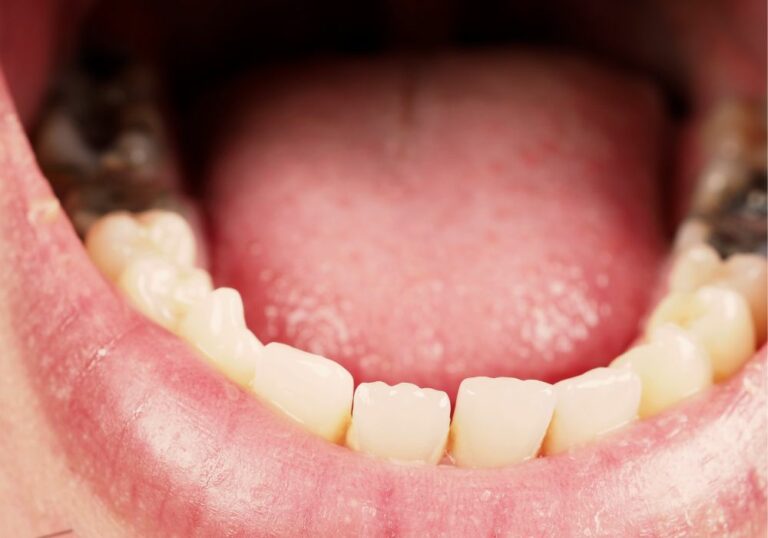 Why Is My Tooth Grey Under My Crown? (Causes & Treatment)