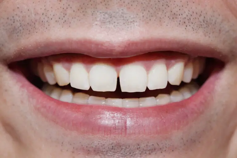 How Can I Fill My Front Teeth At Home? (A Comprehensive Guide)