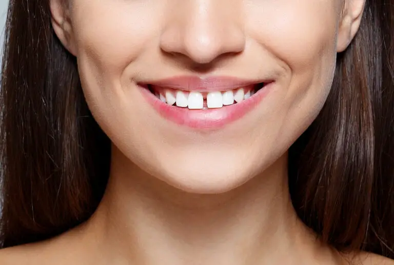 How Can I Hide My Gap In My Teeth? (Causes, Treatments & Tips)
