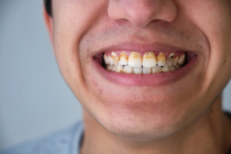 How Can I Prevent Tartar On My Teeth? (8 Effective Ways)
