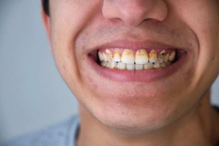 How Can I Prevent Tartar On My Teeth? (8 Effective Ways)