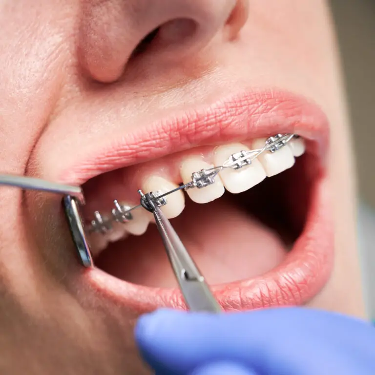 How far can braces move teeth?