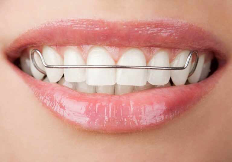 How fast can a retainer move your teeth? (You’d Love To Know)