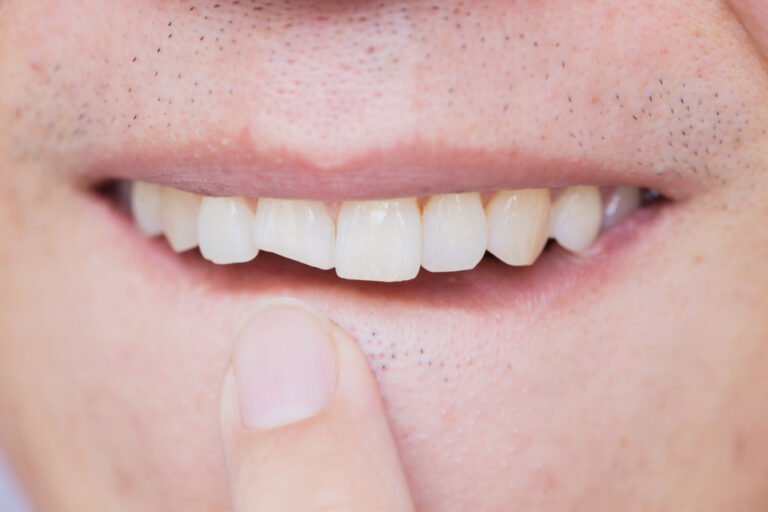 How Long Can A Broken Tooth Be Left? (What To Do With Broken Teeth)