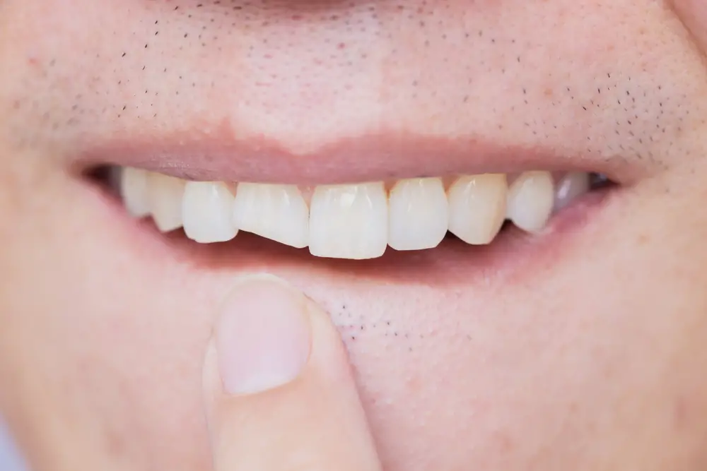 How Long Can A Broken Tooth Be Left What To Do With Broken Teeth 