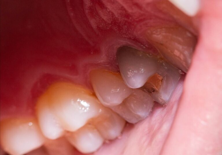 How Long Can a Dead Tooth Stay in Your Mouth? Find Out Here!