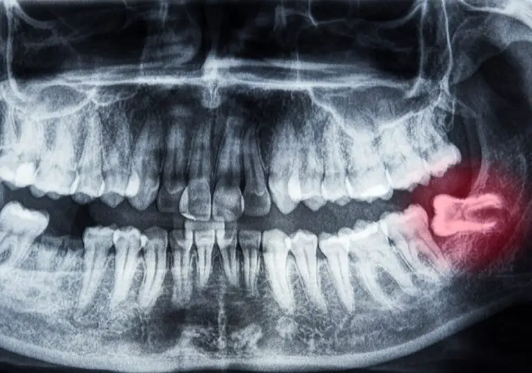 How long can you leave wisdom tooth pain? (Explained)