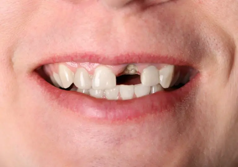 How Quickly Can A Front Tooth Be Replaced? (Replacement Options)
