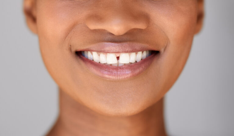How to Fix Gap Between Teeth Without Braces: Simple Solutions