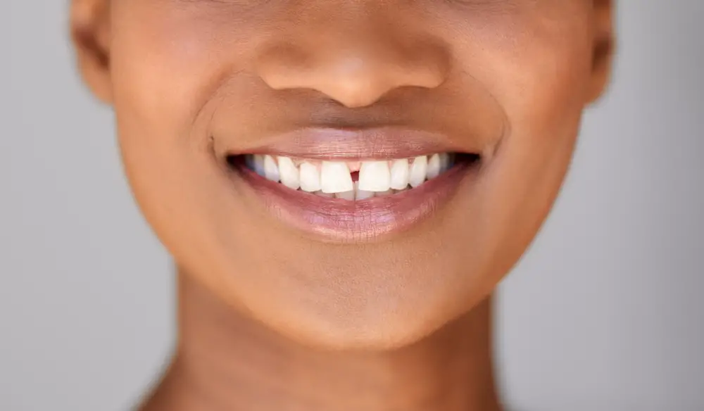 How to Fix Gap Between Teeth Without Braces Simple Solutions