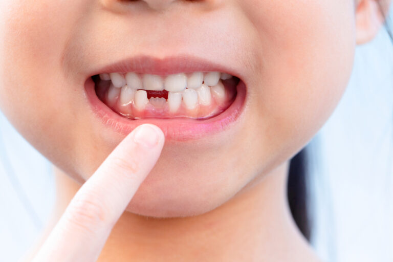 How to Identify If a Permanent Tooth is Emerging