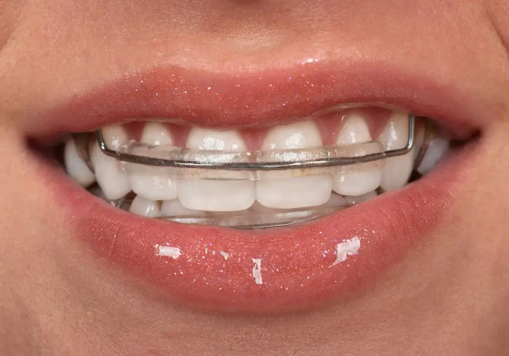 How to Minimize Tooth Movement Without Retainers?