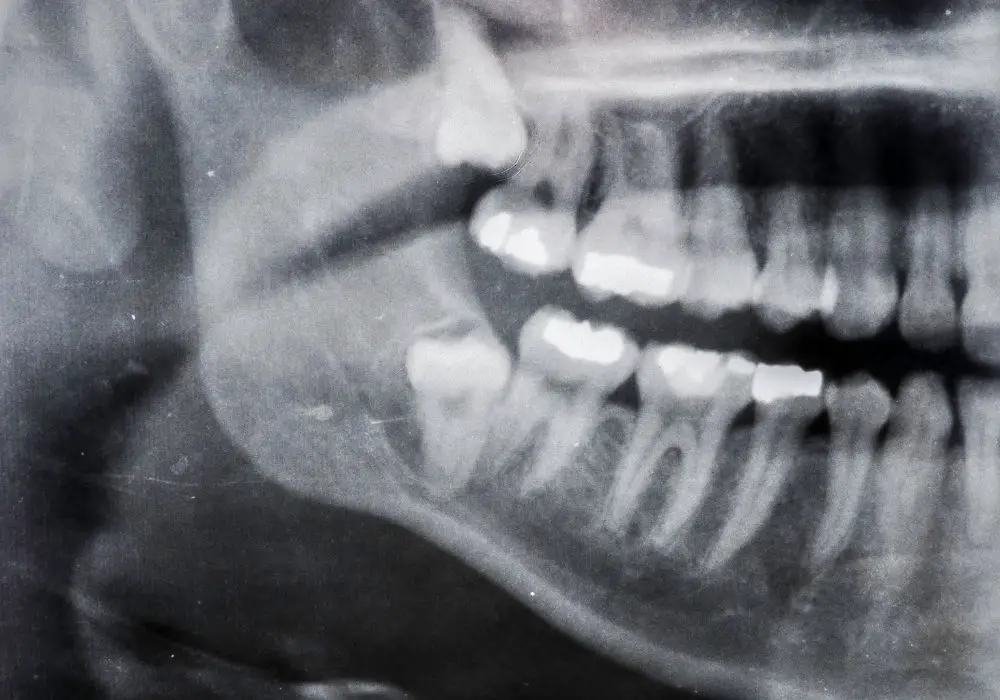 Impaction Problems With Wisdom Teeth