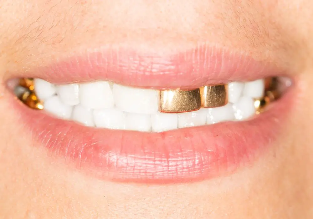 Importance of Keeping Gold Teeth Shiny