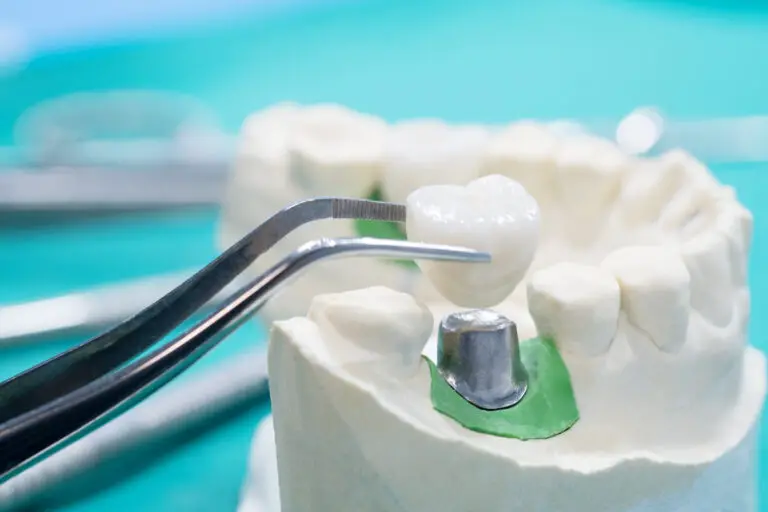 Is A Tooth Cap Permanent? (Everything You Need To Know)
