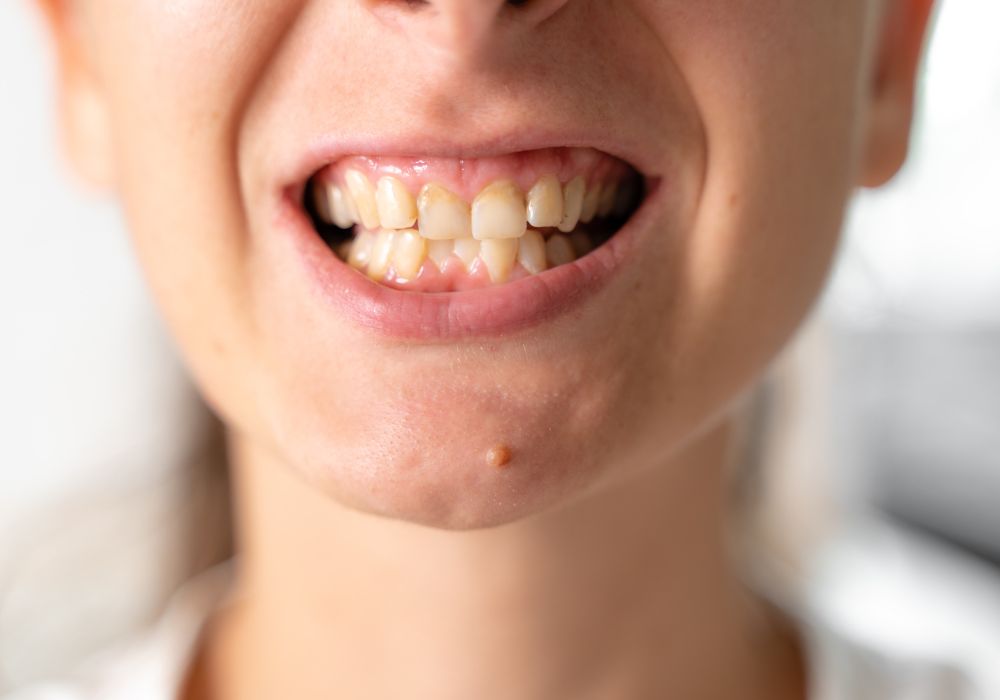 Is it possible to survive with bad teeth
