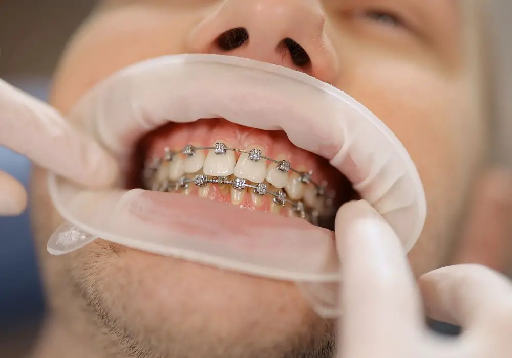 Is professional orthodontic treatment required