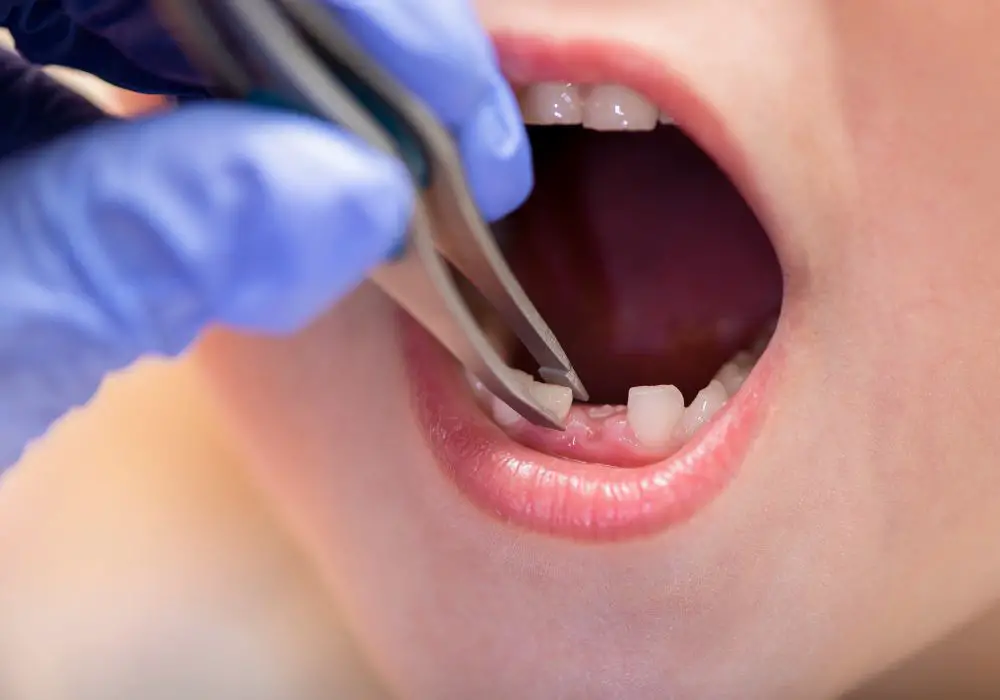 Key Factors That Determine How Many Teeth Can Be Pulled at Once