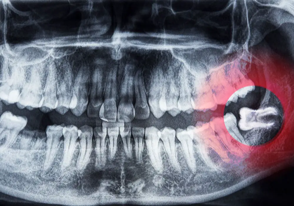 Key Reasons For Unilateral Wisdom Tooth Growth