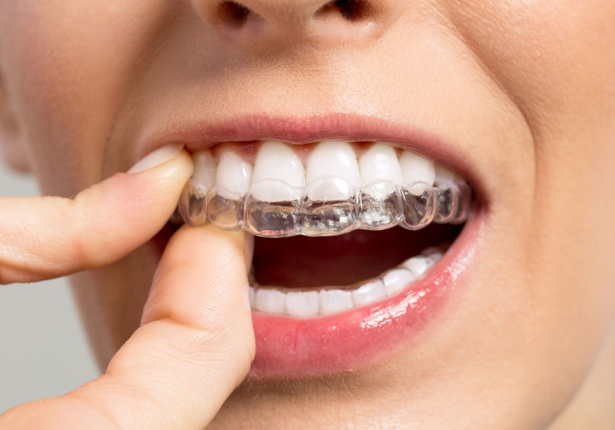 Key steps if pursuing fake teeth instead of traditional braces