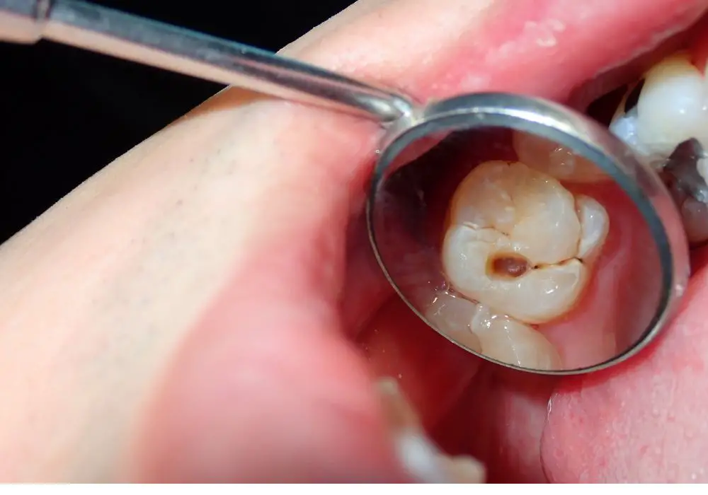 Key steps in restoring damaged teeth