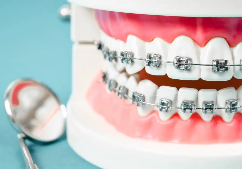Key uses and benefits of braces in dentistry today