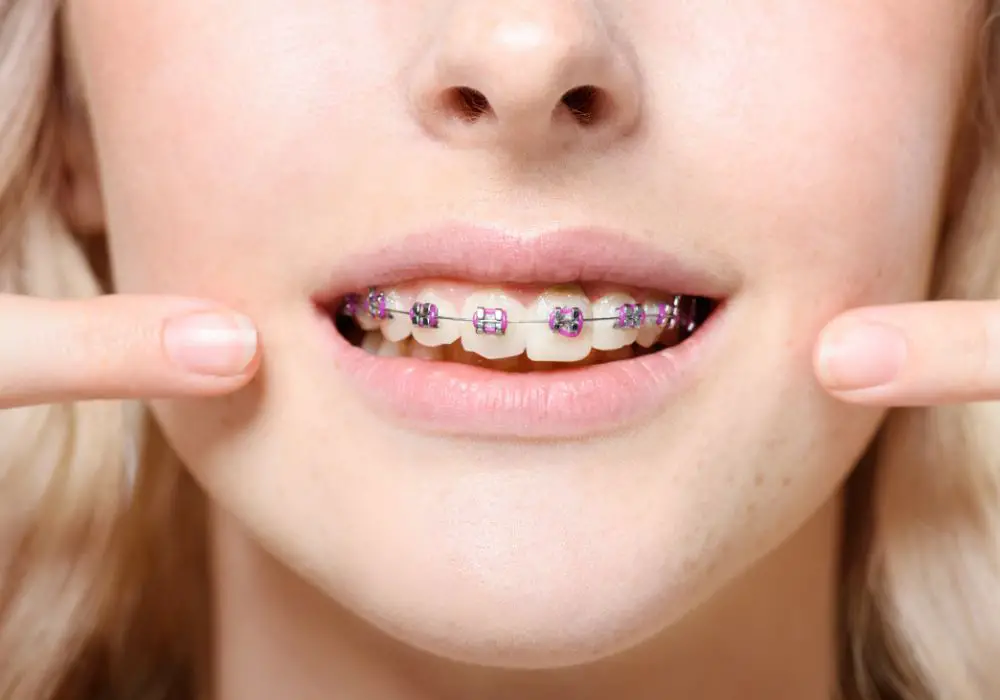Lifestyle habits that can shorten orthodontic treatment time