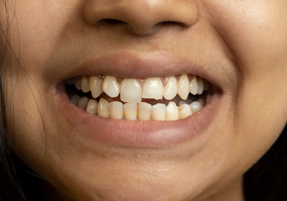 Limitations in Tooth Repair