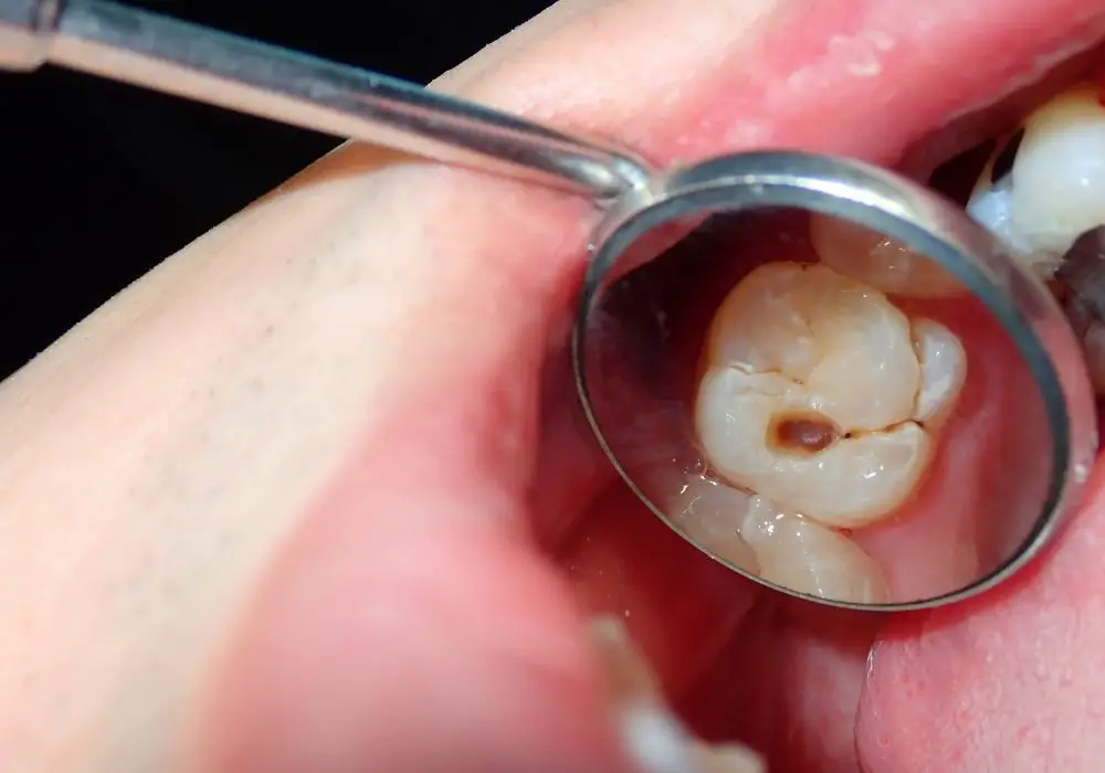 Long-Term Outcomes of Big Cavity Fillings