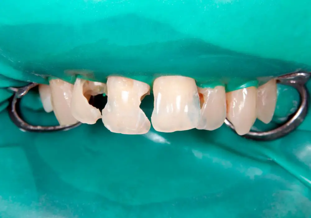 Long-term outlook for crumbling teeth