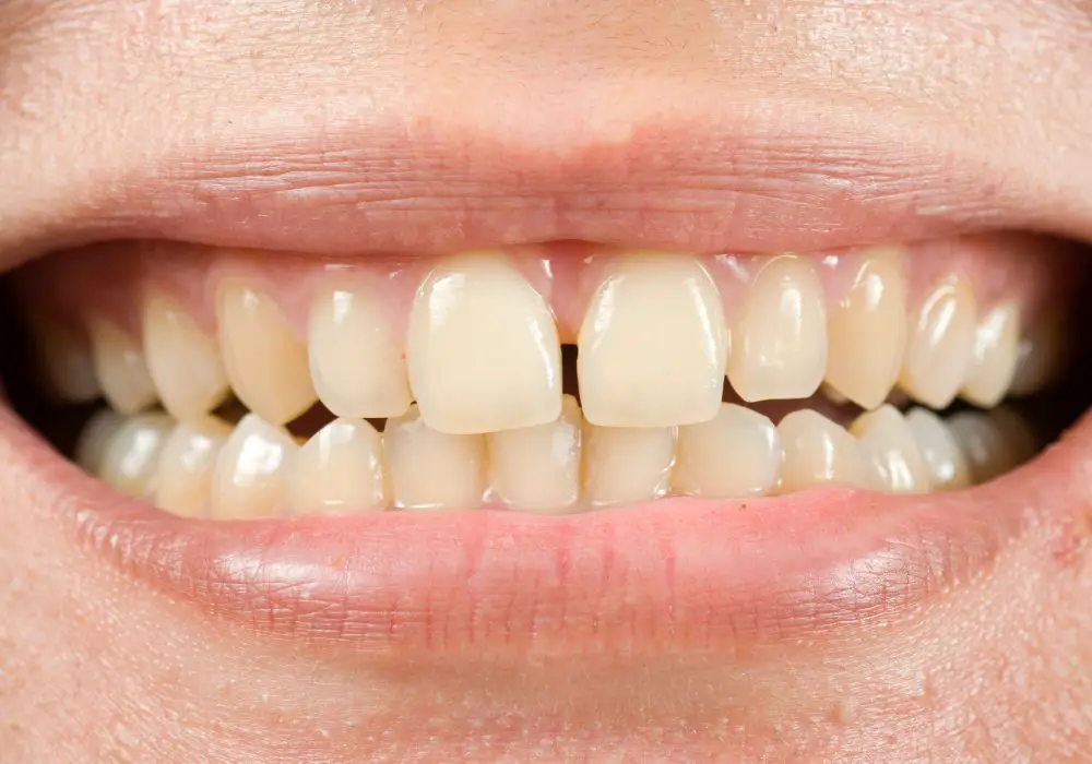 Maintaining Front Tooth Health