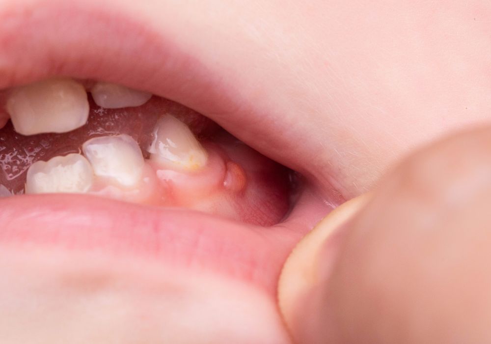 Maintaining Oral Health After Periodontal Disease
