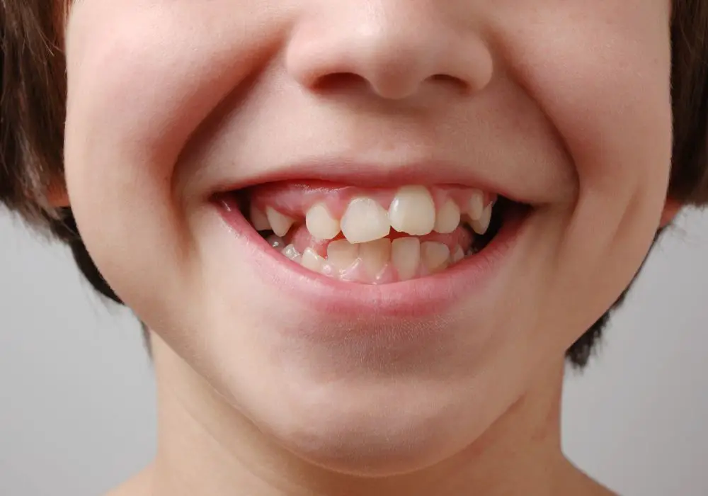 Maintaining Straightened Teeth
