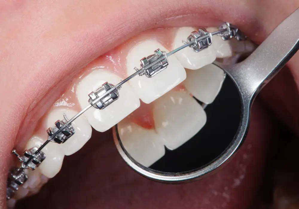 Maintaining clipped teeth long-term