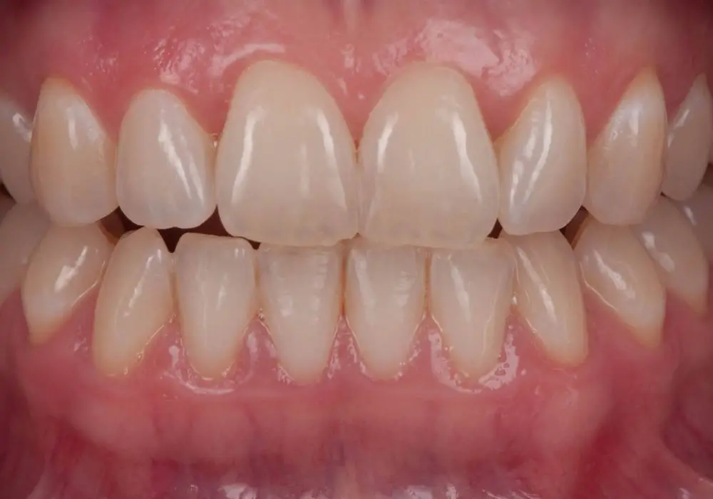 Maintaining corrected tooth alignment