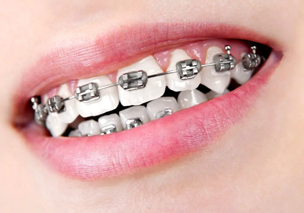 Methods to Brighten Teeth After Braces