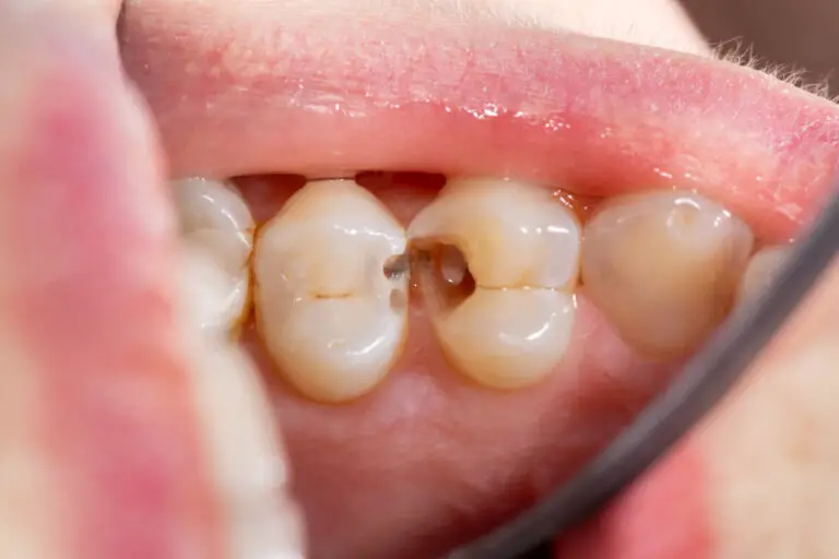 Why Do My Teeth Get Cavities So Easily? (Prevent Cavities From Forming)