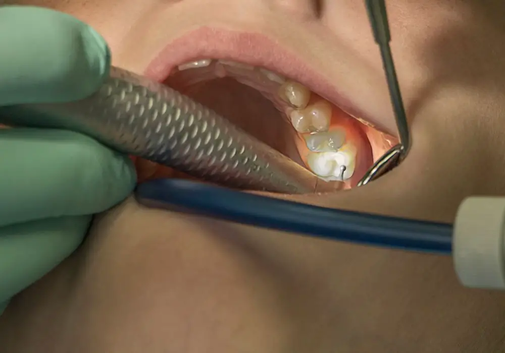 Options for Repairing Broken, Decayed, or Fractured Teeth