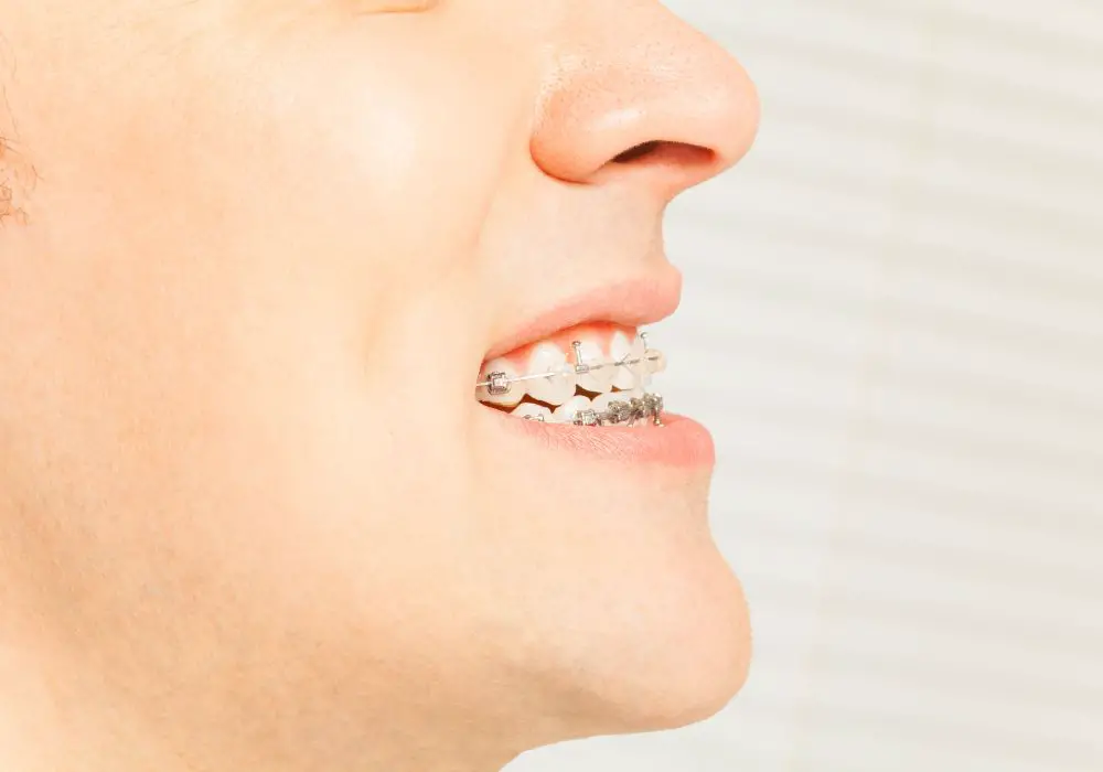 Orthodontic Treatments