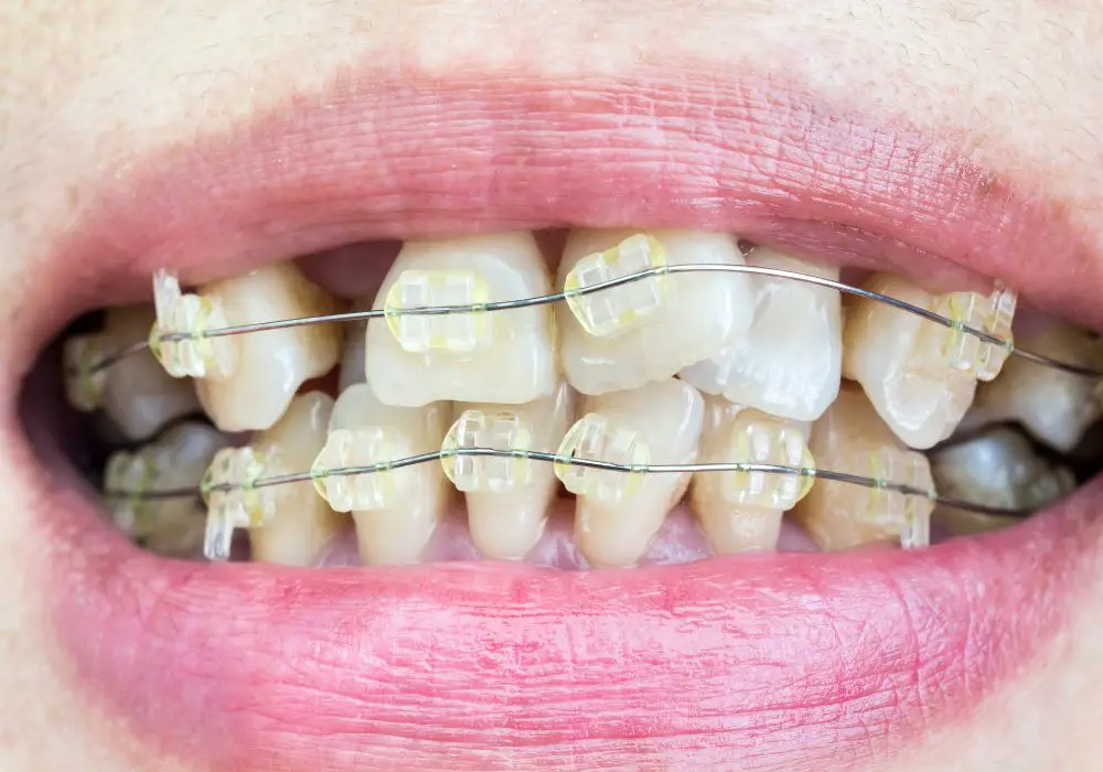 Orthodontic treatment